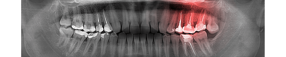 RTG zębów pantomografia i cefalometria