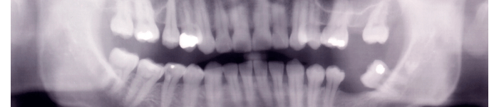RVG zębów